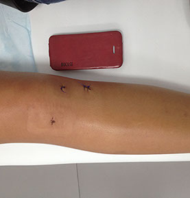 Залавин Владимир Геннадьевич. Челябинск. Врач травматолог-ортопед. Швы после операции.